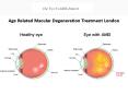 Age Related Macular Degeneration Treatment London PowerPoint PPT Presentation