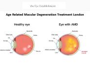 Age Related Macular Degeneration Treatment London