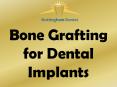 Bone Grafting for Dental Implants PowerPoint PPT Presentation
