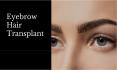 Eyebrow Hair Transplant PowerPoint PPT Presentation