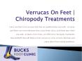 Verrucas On Feet | Chiropody Treatments | Foot Doctor Beaconsfield PowerPoint PPT Presentation