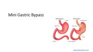 Mini Gastric Bypass/Single anastomosis Gastric By-pass