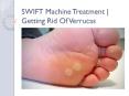 SWIFT Machine Treatment | Getting Rid Of Verrucas | Chiropodist PowerPoint PPT Presentation