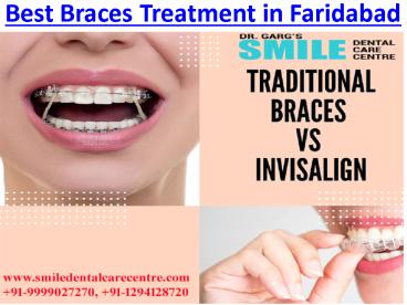 Best Braces Treatment and Orthodontist in Faridabad / Delhi