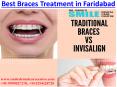 Best Braces Treatment and Orthodontist in Faridabad / Delhi PowerPoint PPT Presentation