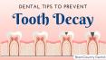 Dental Tips to Prevent Tooth Decay by the Dentist in Brampton PowerPoint PPT Presentation