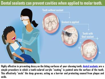 Dental Sealants in the Virgin Islands presentation | free to download