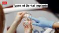 Types of Dental Implants PowerPoint PPT Presentation