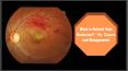 What is Retinal Vein Occlusion? - Its  Causes and Management PowerPoint PPT Presentation
