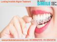 Invisible Aligner Treatment in Faridabad Location PowerPoint PPT Presentation