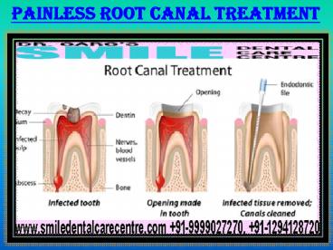 Painless Root Canal Treatment in Faridabad Area