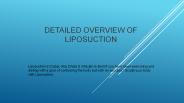 Detailed Overview of Liposuction