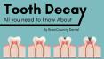 Tooth Decay: All you need to know About by Family Dentist Brampton PowerPoint PPT Presentation