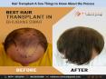 Hair Transplant A Few Things to Know About the Process PowerPoint PPT Presentation