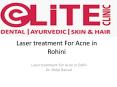 Laser treatment For Acne in Rohini PowerPoint PPT Presentation