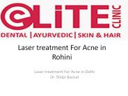 Laser treatment For Acne in Rohini