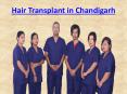 Hair Transplant in Chandigarh PowerPoint PPT Presentation