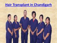 Hair Transplant in Chandigarh