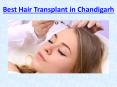 Best Hair Transplant in Chandigarh (1) PowerPoint PPT Presentation