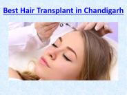 Best Hair Transplant in Chandigarh (1)