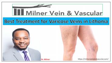 Best Treatment for Varicose Veins in Lithonia, GA