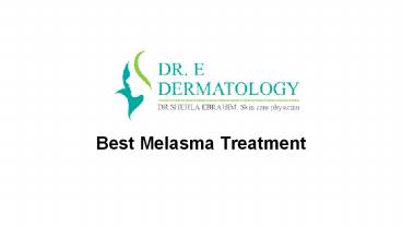 Best Melasma treatment in Vancouver bc