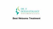 Best Melasma treatment in Vancouver bc