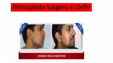 Rhinoplasty Surgery in Delhi