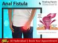 Anal Fistula Treatment in Hyderabad PowerPoint PPT Presentation