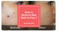 Skin Mole Remover PowerPoint PPT Presentation