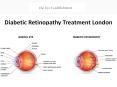 Diabetic Retinopathy Treatment London PowerPoint PPT Presentation