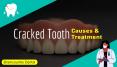 Cracked Tooth Causes and Treatment by Brampton Dentist PowerPoint PPT Presentation