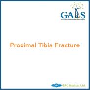 Proximal Tibia Fracture