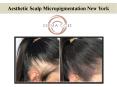Aesthetic Scalp Micropigmentation New York PowerPoint PPT Presentation