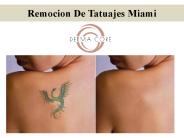 Remocion De Tatuajes Miami