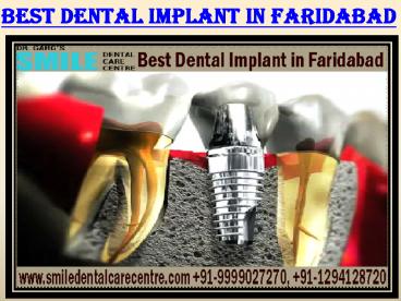 Best Dental Implant Clinic Availability in Faridabad