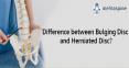 Difference between Bulging Disc and Herniated Disc? |Mehta Spine UK PowerPoint PPT Presentation