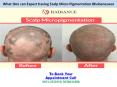 What One can Expect having Scalp Micro Pigmentation Bhubaneswar PowerPoint PPT Presentation
