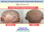 What One can Expect having Scalp Micro Pigmentation Bhubaneswar