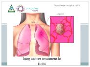 lung cancer treatment in Delhi