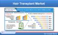 Hair Transplant Market, By Methods, Region, Companies, Forecast PowerPoint PPT Presentation