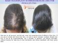 Hair Transplant in Bhubaneswar are for Females Too PowerPoint PPT Presentation