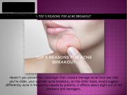 TOP 5 REASONS FOR ACNE BREAKOUT