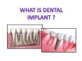 What is Dental Implant ? PowerPoint PPT Presentation