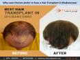Why even Doctors prefer to have a Hair Transplant in Bhubaneswar PowerPoint PPT Presentation