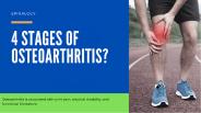 4 Stages of Osteoarthritis