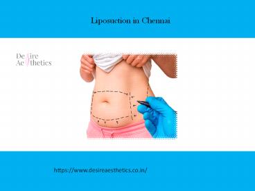 Liposuction in Chennai