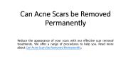 Can Acne Scars be Removed Permanently in Dubai
