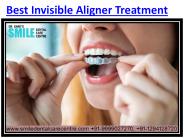 Best Invisible Aligner Treatment and Orthodontists (1)