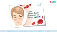 Can Stem Cells be Used to Treat Lupus?